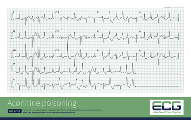 In aconitine poisoning, the atrium is inhibited, the amplitude of P wave decreases or atrial fibrillation occurs; ventricular triggering activity increased and ventricular arrhythmia occurred.