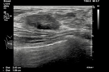 Image of breast ultrasound for breast cancer checks in women with breast mass.A female with a...