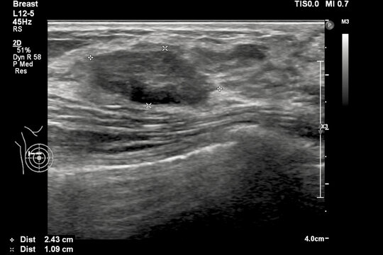 Image of breast ultrasound for breast cancer checks in women with breast mass.A female with a breast lump was done ultrasonography for breast cancer or tumor screening in the hospital.