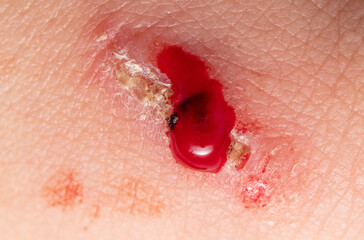Fototapeta premium Wound on human skin. Macro