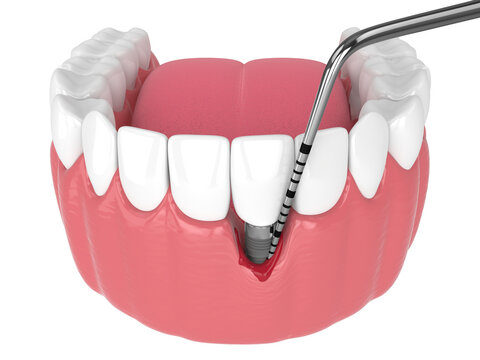 3d render of human jaw with peri implantitis disease and periodontal sonda