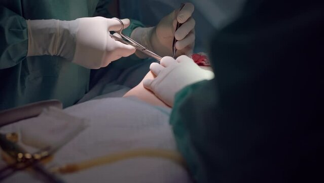 Unrecognizable surgeon using surgical forceps and scissors in slow motion in operating room. Doctor and nurse performing surgery on female Caucasian breast. Plastic aesthetic surgery concept