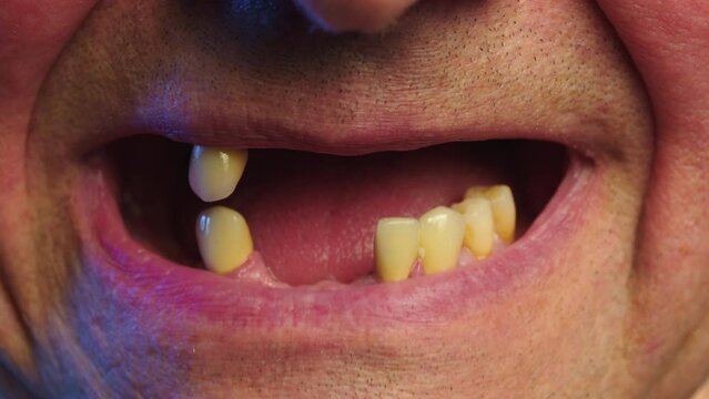 Periodontal disease and missing teeth in an elderly man. Close up shot of a toothless male mouth. Man showing his rotten teeth, caries, decayed and weak enamel, teeth falling out, dental problems