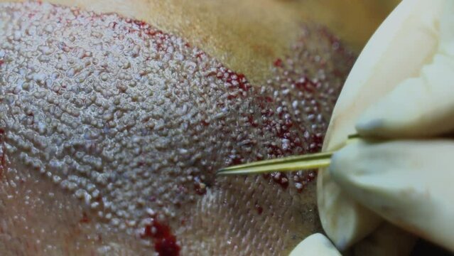 FUE Hair Transplant Patient in Clinic. Hair transplant patient in the end of the operation