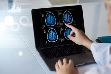 Brain x ray, computer results and doctor hands with digital report graphic about neurology. Anatomy, xray and assessment data with a healthcare employee with mri test information in a hospital - obrazy, fototapety, plakaty