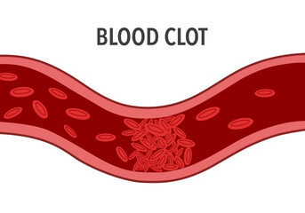 Blood clot in vein flat design on white background.