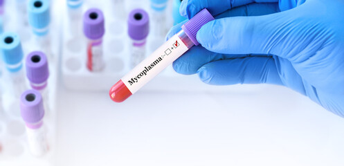 Doctor holding a test blood sample tube positive with Mycoplasma test on the background of medical test tubes with analyzes.Banner.