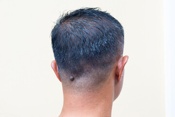 
A large mole on the man's head.wart nodules.