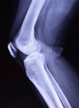 A snapshot of the knee joint with a diagnosis of gonarthrosis. Arthrosis of the knee joint snapshot.