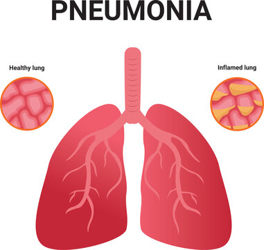 Pneumonia. Normal and infected alveoli. Healthy and illness lungs cartoon flat icon