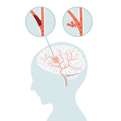 Ischemic stroke and hemorrhagic stroke, stroke brain concept in flat vector.