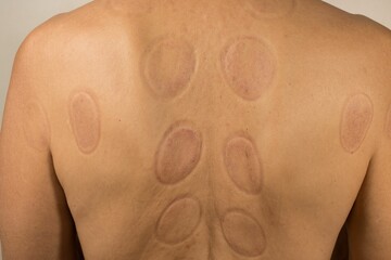 Mature man that had Cupping Therapy done on his back for pain relief