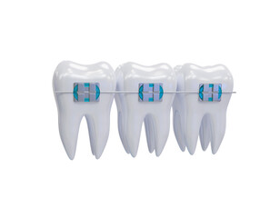 Teeth metal braces. Teeth alignment. Three white teeth with braces on a transparent background. PNG. 3d render