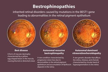 Bestrophinopathies, inherited retinal disorders caused by mutations in the BEST1 gene, 3D illustration