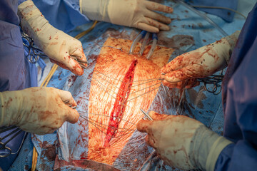 Two heart surgeons close the chest with wires after a bypass operation. Concept: health and cardiac...