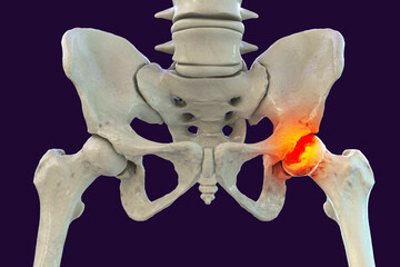 Femur bone affected by Legg-Calve-Perthes Disease, a childhood hip disorder, 3D illustration - obrazy, fototapety, plakaty