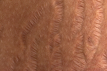 Close up human Skin natural stretch marks Texture background