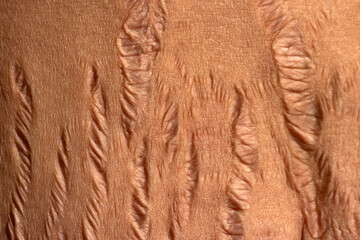 Close up human Skin natural stretch marks Texture background