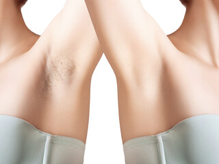 Woman's armpit with before and after epilation.