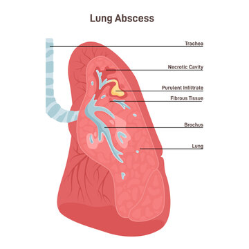 Lung Abscess. Microbial Infection Of The Lung Causing Necrosis Of The Pulmonary