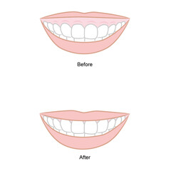 Before and after gummy smile treatment