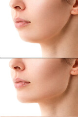 Close-up portrait of a woman before and after a chin correction procedure with neck liposuction....