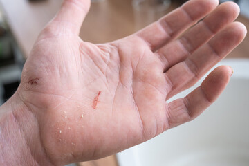 A cut on a man's palm in close-up. Household skin damage with a sharp cutting object, first aid