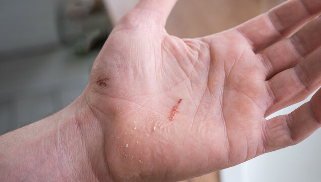A cut on a man's palm in close-up. Household skin damage with a sharp cutting object, first aid