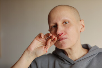 Hairless cancer sick female patient is bleeding from her nose, effects of chemotherapy. Young bald...