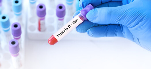 Doctor holding a test blood sample tube with Vitamin D test on the background of medical test tubes with analyzes