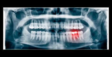 Dental x-ray orthopanoramic with red zone indicating the patient's pain point. Lower arch molar...