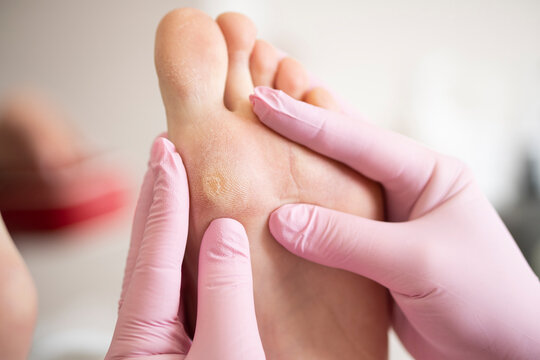 Close-up of calluses on the foot. Painful callus on the leg..