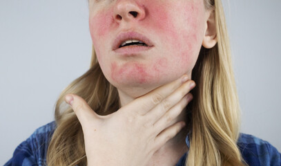 Rosacea face. The girl suffers from redness on her cheeks. Couperosis of the skin. Redness and...