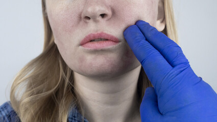 Enlarged pores. Close-up of skin with large pores. Dermatology and cosmetology. Treatment of...