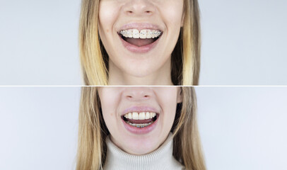Before and after remove braces. On left is a girl in a metal bracket system, and on right are...