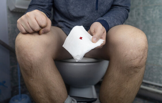 Hemorrhoid concept. A man sits on the toilet and holds white toilet paper in his hands. There is a little drop of blood on it. Aesthetic presentation of problems with the rectum.