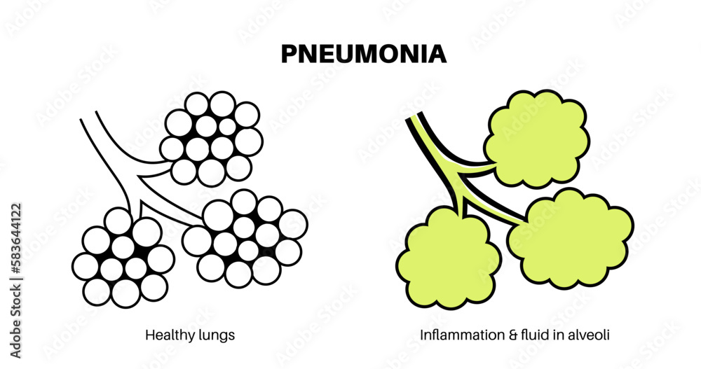 Sticker Pneumonia infection poster