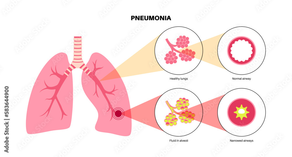 Poster Pneumonia infection poster