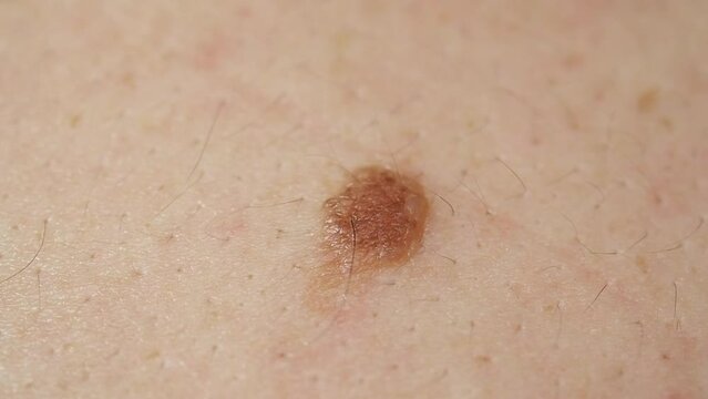 Mole birthmark nevus macro on human skin. crochordon or soft fibroma close up. dermatology problem skin concept