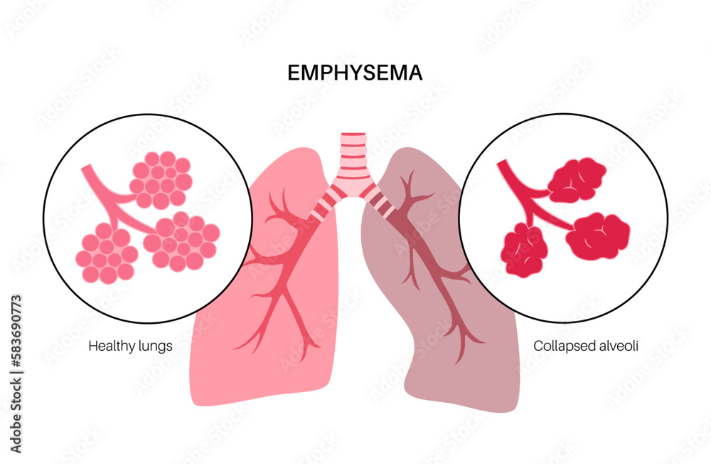 Canvas Prints Emphysema anatomical poster