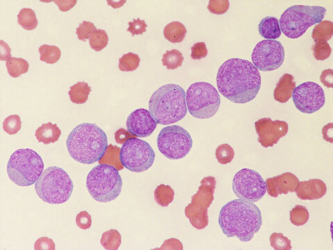 Leukemia, blood cells, blast  cells in Acute  myeloid Leukemia (AML)