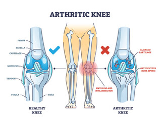 Arthritic knee or osteoarthritis and healthy bones comparison outline diagram. Labeled educational scheme with damaged cartilage and bone spurs diagnosis vector illustration. Anatomical skeletal leg. - obrazy, fototapety, plakaty