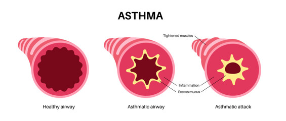 Asthma lung disease - 584070987