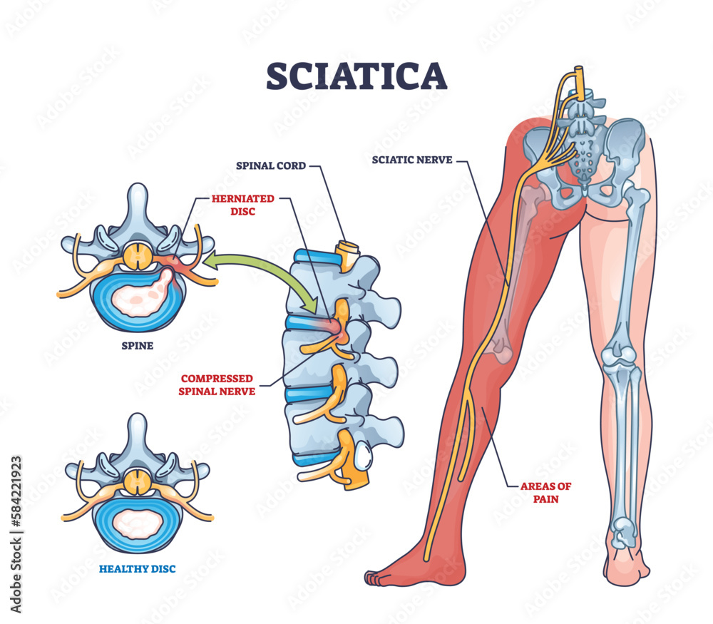 Sticker Sciatica as symptom from herniated disc and spinal nerve outline diagram. Labeled educational scheme with medical condition from compressed nerves and compared with healthy disc vector illustration.