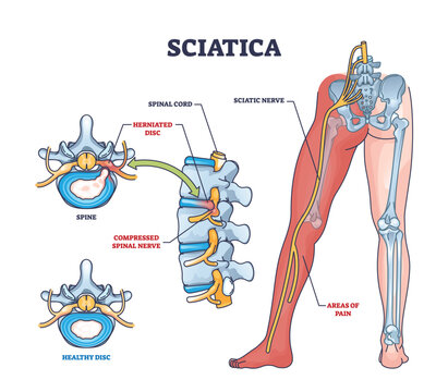 Sciatica as symptom from herniated disc and spinal nerve outline diagram. Labeled educational scheme with medical condition from compressed nerves and compared with healthy disc vector illustration.