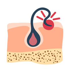 Ingrown hair. Inflammation, skin problems. Anatomy infographics of hair. Vector illustration isolated on the white background.