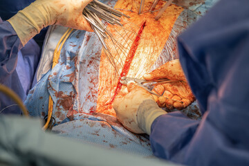 Two heart surgeons close the chest with wires after a bypass operation. Concept: health and cardiac...