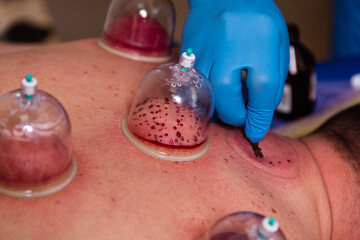 The doctor practices therapeutic massage, vacuum massage and hijama