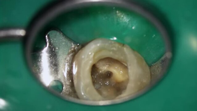 Macro of decay tooth with deep hole treated by dentist in professional clinic. Closeup view of rotten molar and doctor filling it with medicine to clean canals. Stomatology pathology checkup concept