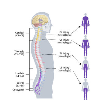 척수손상 마비부위 메디컬일러스트